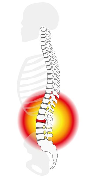 脊髄の椎間板脱出 - ベクター画像