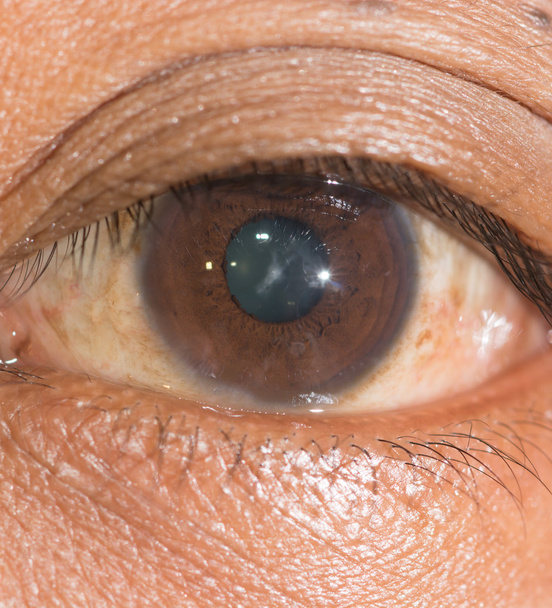 exame ocular, catarata sutural
 - Foto, Imagem