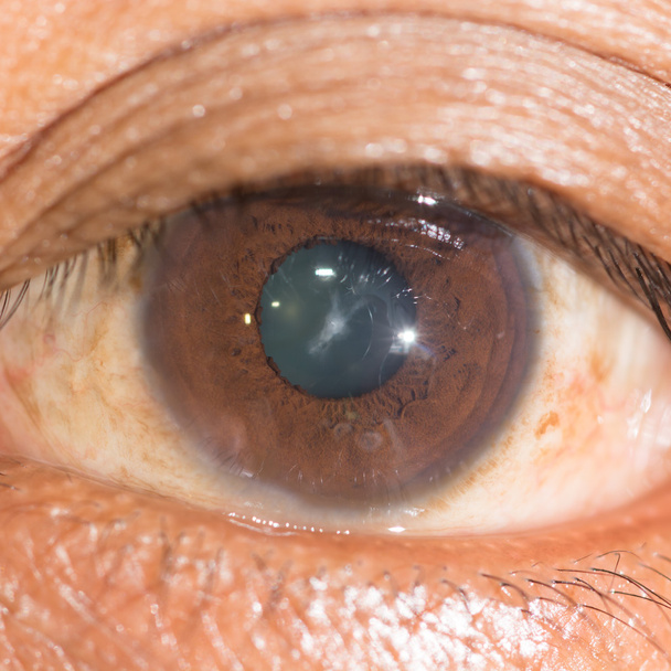examen des yeux, cataracte suturale
 - Photo, image