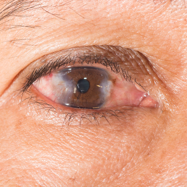 eye exam, advance pterygium - Photo, Image