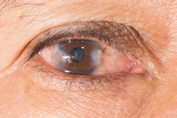 badanie wzroku, z góry pterygium - Zdjęcie, obraz