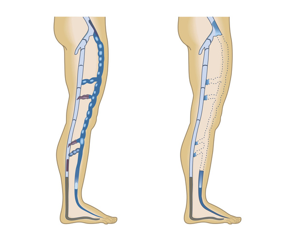 ilustración piernas venas sobre un fondo blanco
 - Vector, Imagen
