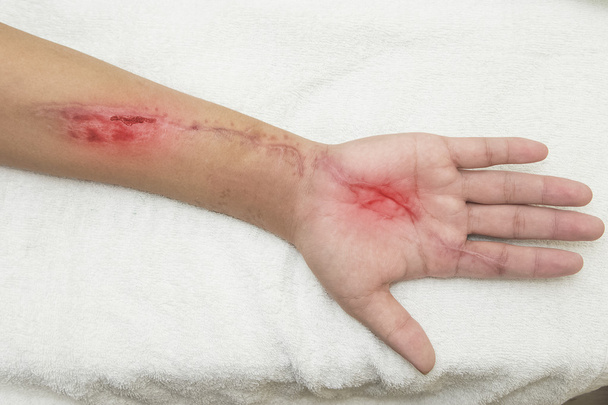 herida de hinchazón en el afán
 - Foto, imagen