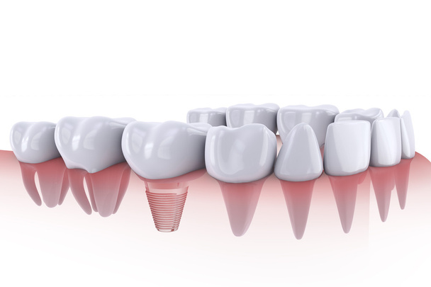 dentes e implante
 - Foto, Imagem
