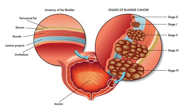 στάδια του καρκίνου της ουροδόχου κύστης αρσενικό - Διάνυσμα, εικόνα