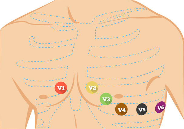 Hrudník EKG vede umístění obrázku. Šest barevných Elektrokardiografické vede - Vektor, obrázek