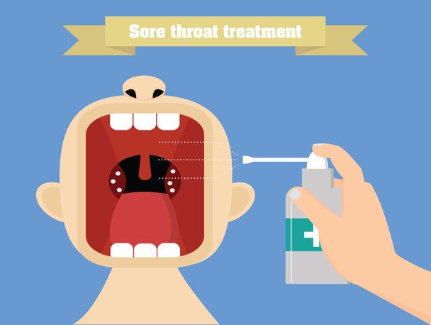 エアロゾルと喉の痛みの治療。扁桃腺炎の治療概念図 - ベクター画像