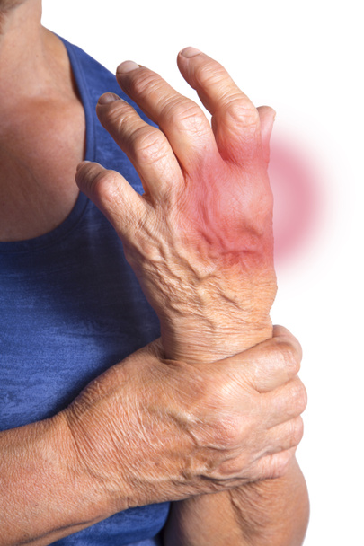 Hand vervormd van reumatoïde artritis - Foto, afbeelding