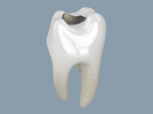 diente con relleno
 - Foto, Imagen