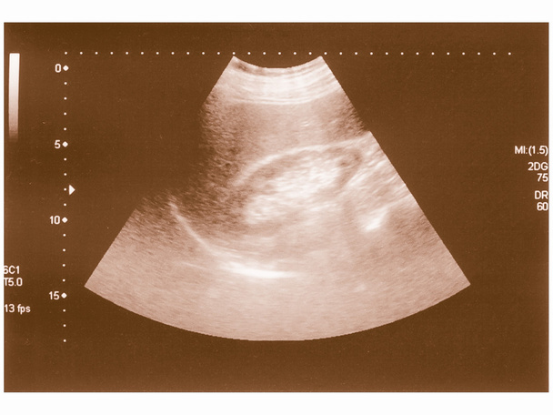 Retro näköinen ultraääni skannaus
 - Valokuva, kuva