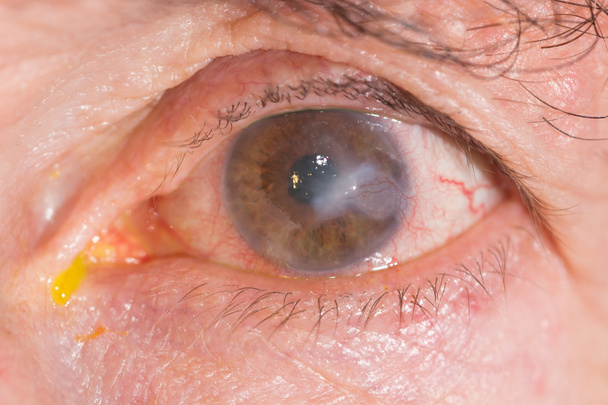 exame ocular, queratite intersticial
 - Foto, Imagem