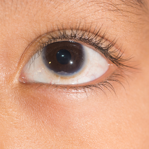 badanie wzroku, wrodzone problem rogówki - Zdjęcie, obraz