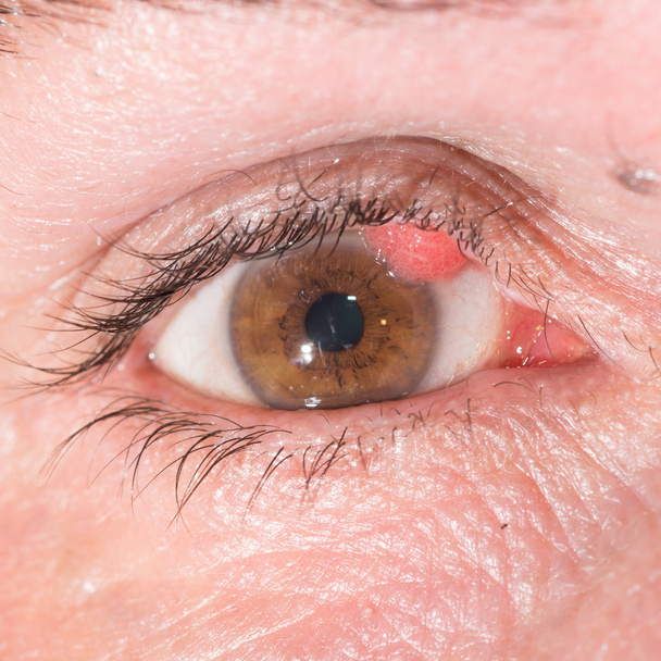 eye exam, papilloma - Photo, Image