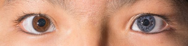 examen ocular, iris heterocromático
 - Foto, imagen