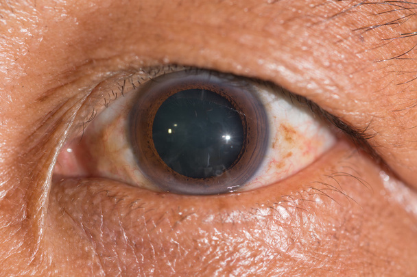 eye exam, dilated pupil - Photo, Image
