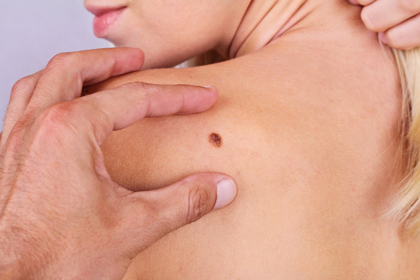 Doctor, dermatologist, hands examines a birthmark of patient. Checking benign moles - Фото, изображение