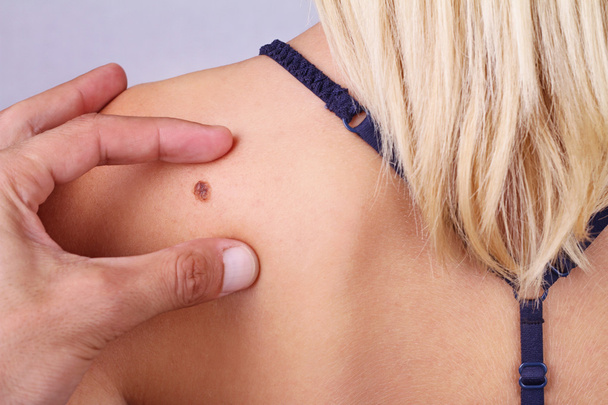 Doctor, dermatologist, hands examines a birthmark of patient. Checking benign moles - Photo, Image