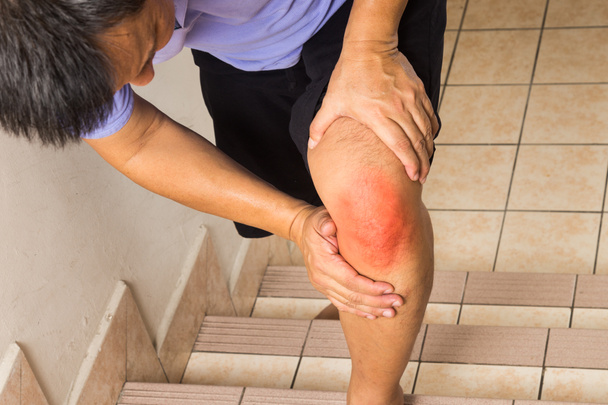 Homme mûr souffrant de douleurs articulaires aiguës au genou escalade
 - Photo, image