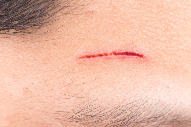 Primo piano di ferita dolorosa sulla fronte da taglio profondo
 - Foto, immagini