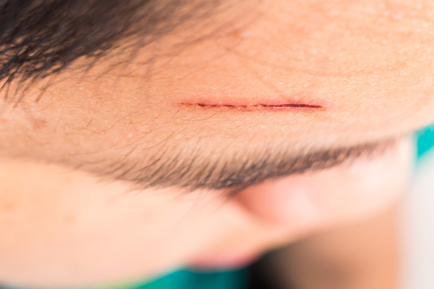 Close up overhead view of painful wound on forehead from deep cut - Photo, Image