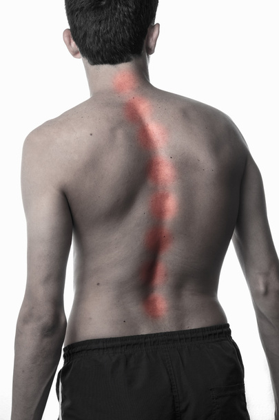 scoliosis, thin man on his back, no shirt. curvature of the spin - Фото, изображение