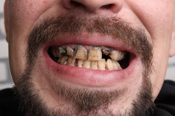 Χαλασμένα δόντια καπνιστής άρρωστος - Φωτογραφία, εικόνα