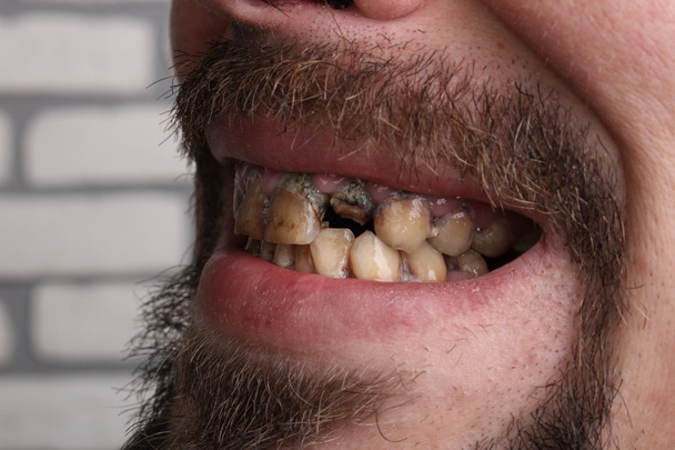 Χαλασμένα δόντια καπνιστής άρρωστος - Φωτογραφία, εικόνα