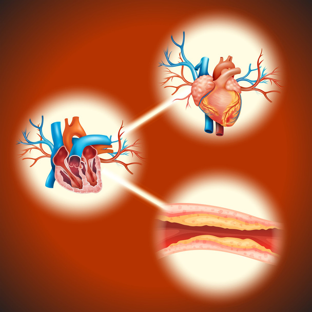 Cholesteral dans le cœur humain
 - Vecteur, image