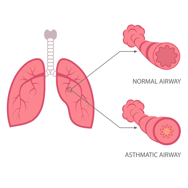 asthma illustration, bronchial, lungs respiratory - Vector, Image