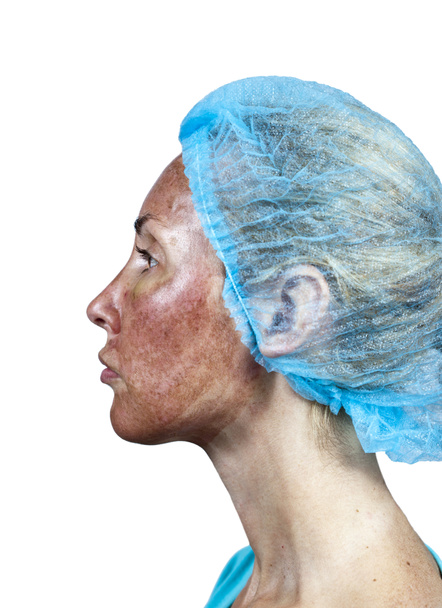 Cosmetology.Skin в процесі відмови після глибока хімічний пілінг. Границя між оброблені і здорова шкіра на шиї - Фото, зображення