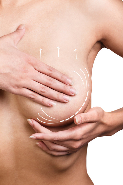 Correction des seins avec l'aide de la chirurgie plastique
 - Photo, image