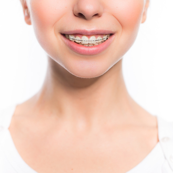 Woman mouth with teeth braces - Foto, Imagem