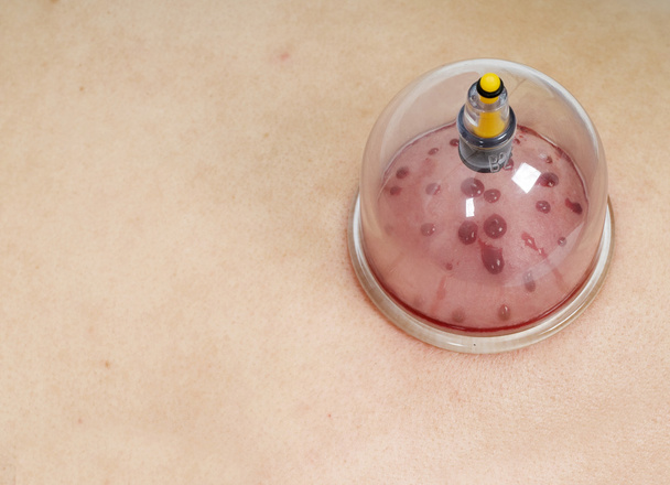Veri lääketieteellisessä kuppaus hoito tyhjiö cup
 - Valokuva, kuva