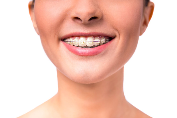 Woman with braces - Foto, Imagen