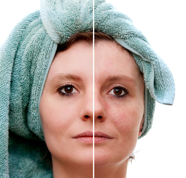 Женщина с пятнистой кожей с глубокими порами и черной головой и зажившей мягкой кожей - до и после
 - Фото, изображение