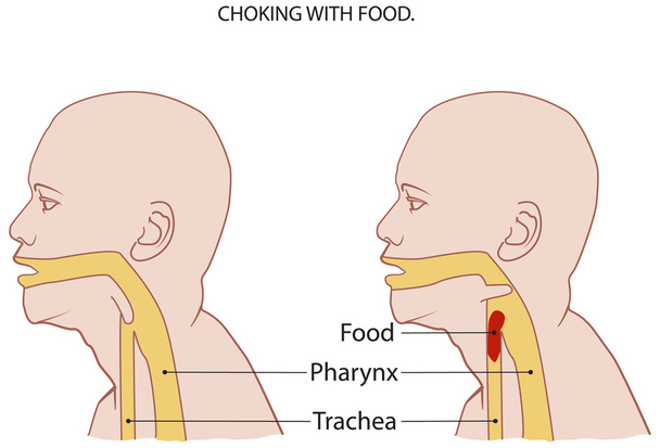 Choking - Vector, Image