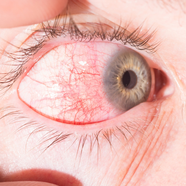 episcleritis σε εξέταση οφθαλμών - Φωτογραφία, εικόνα