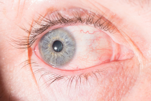 episclerite all'esame oculare
 - Foto, immagini
