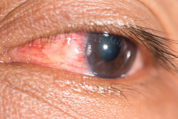 corpo estraneo corneale, esame oculare
 - Foto, immagini