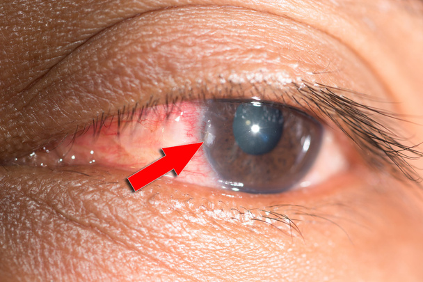 corneal foreign body, eye exam - Photo, Image
