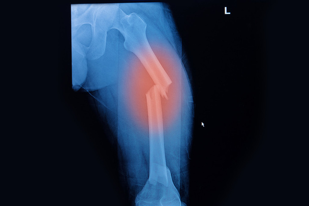 Κάταγμα μηρού, σπασμένο πόδι ακτινογραφίες εικόνας - Φωτογραφία, εικόνα