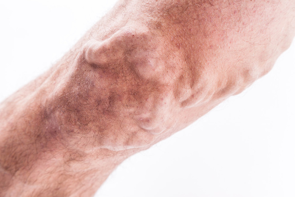 People with varicose veins of the lower extremities and venous t - Φωτογραφία, εικόνα