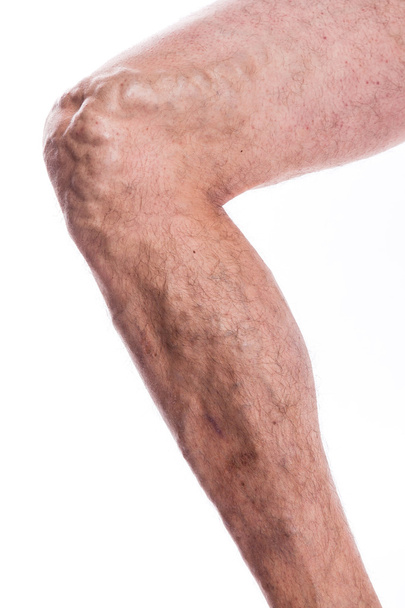 People with varicose veins of the lower extremities and venous t - Fotografie, Obrázek