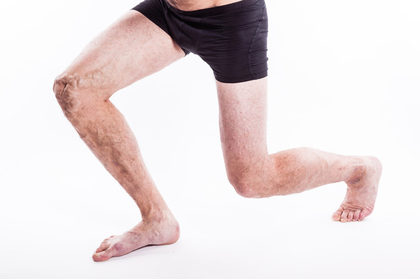 People with varicose veins of the lower extremities and venous t - Foto, afbeelding
