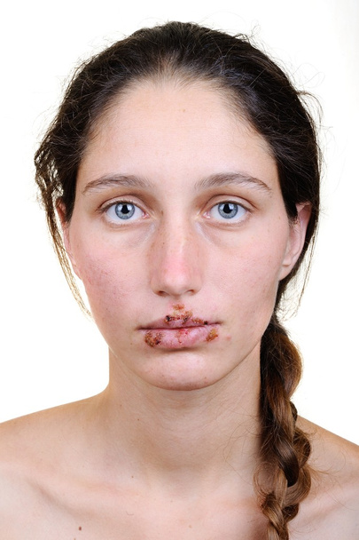 ヘルペス ウイルスを持つ女性 - 写真・画像