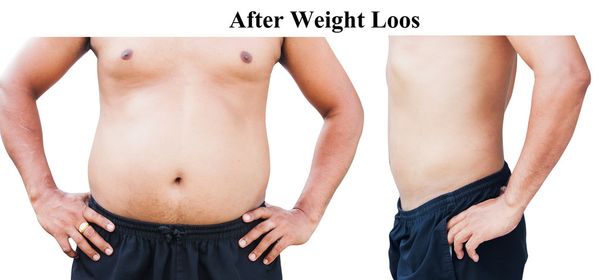 antes y después del vientre gordo del hombre del cuerpo después de la pérdida de peso
 - Foto, imagen