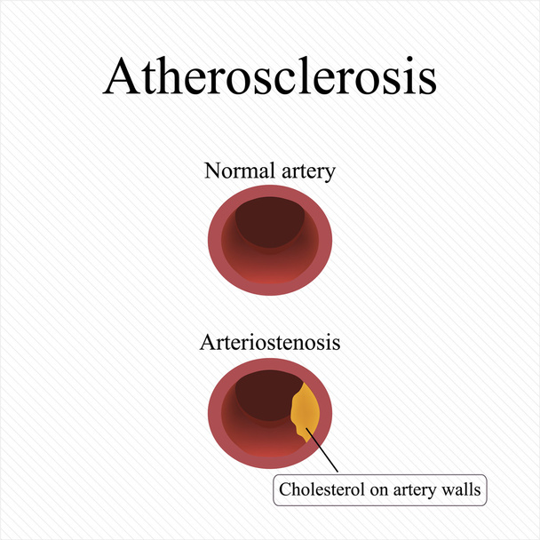 Arteriosklerose. hoher Cholesterinspiegel im Blut. Vektorillustration - Vektor, Bild