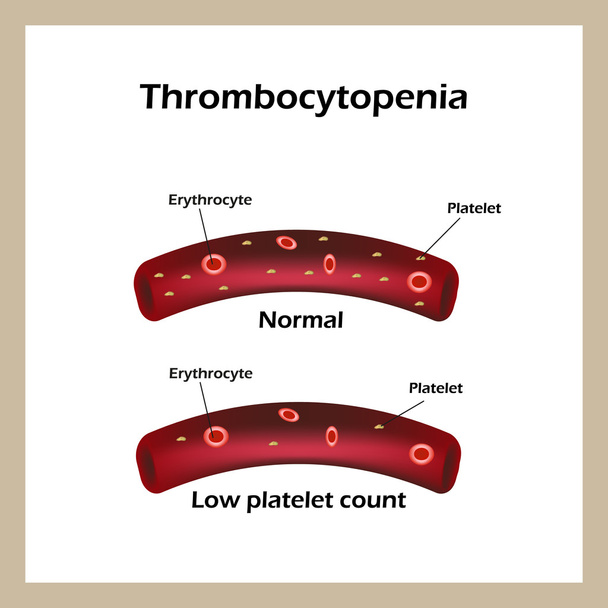 Trombocytopenie. Lagere niveaus van thrombocyten in het bloed. Infographics. Vectorillustratie - Vector, afbeelding