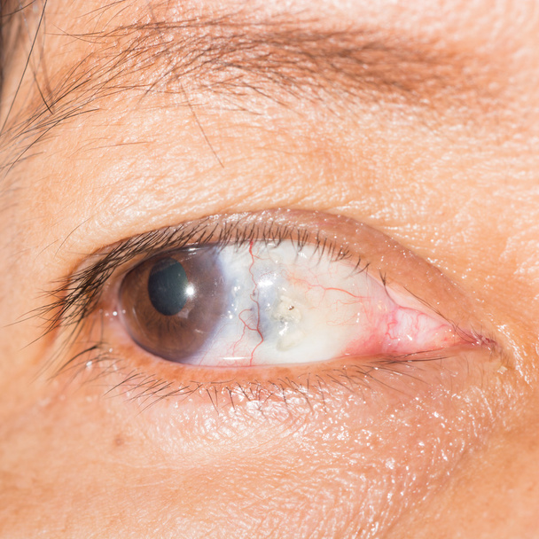 fusión escleral en la prueba ocular
 - Foto, Imagen