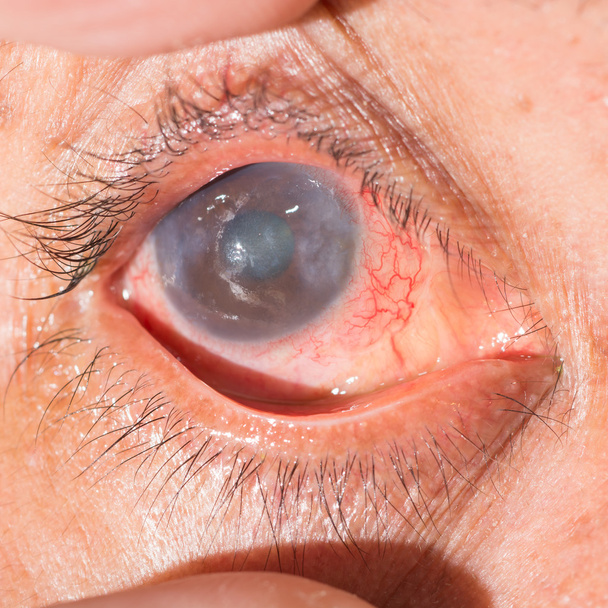 acute anterior uveitis at eye test - Photo, Image